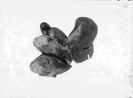 Pathological specimen.