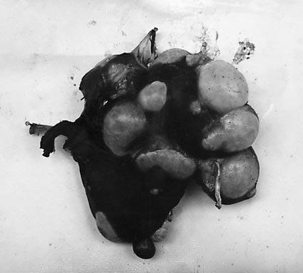 Cover pathological photographs of Hydatid Cysts