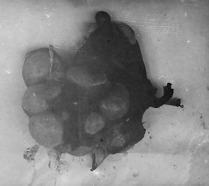Cover pathological photographs of Hydatid Cysts