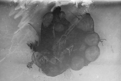 Cover pathological photographs of Hydatid Cysts