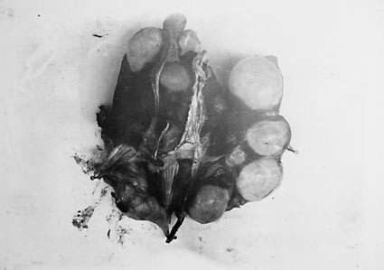 Cover pathological photographs of Hydatid Cysts